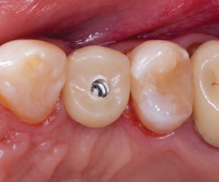 screwretained crown New Jersey Local Dental Lab, Itero